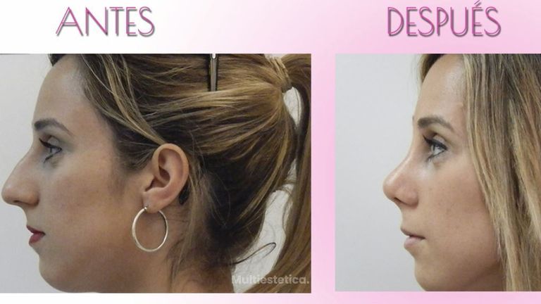 Testimonio Rinoplastia