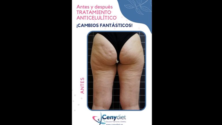 Celulitis - Cenydiet