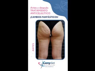 Celulitis - Cenydiet