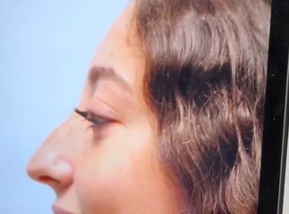 2 meses después de su cirugía