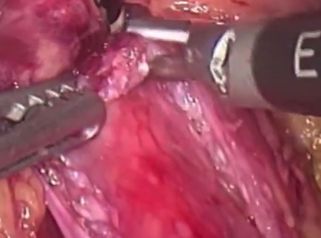 Intervención de acalasia con miotomia de Heller