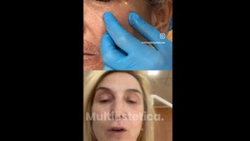 Blefaroplastia sin cirugía - Clínica Thous