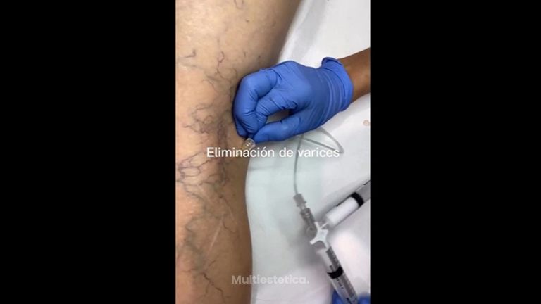Tratamiento varices - BeClinic