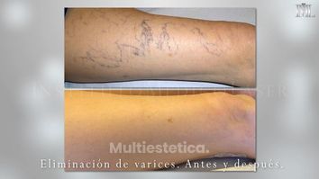 Instituto Médico Láser -IML- Tratamiento de Varices