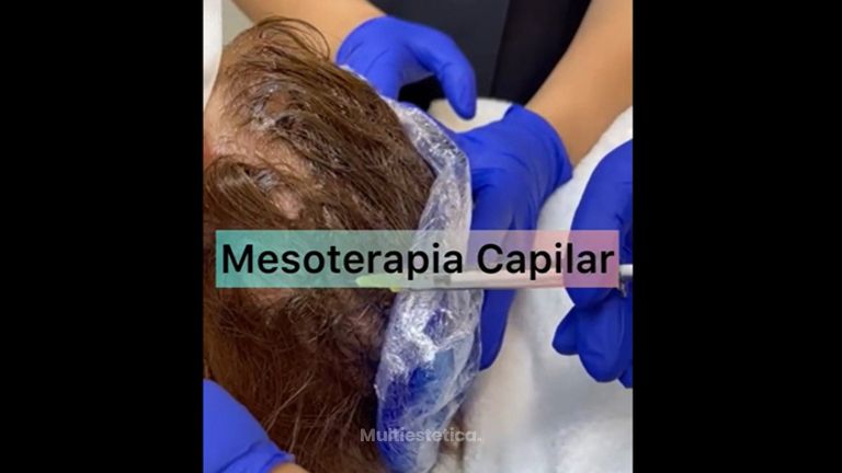 Mesoterapia Capilar - ClinicaAlbayC