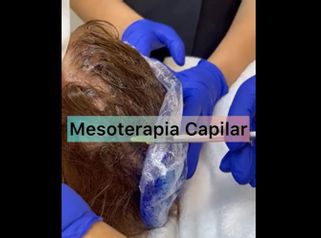Mesoterapia Capilar - ClinicaAlbayC
