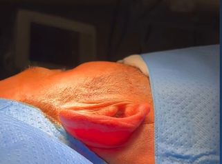 Otoplastia - Clinica Silvia Roson