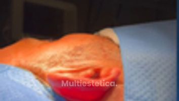 Otoplastia - Clinica Silvia Roson