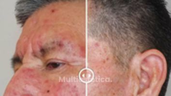 ROSACEA