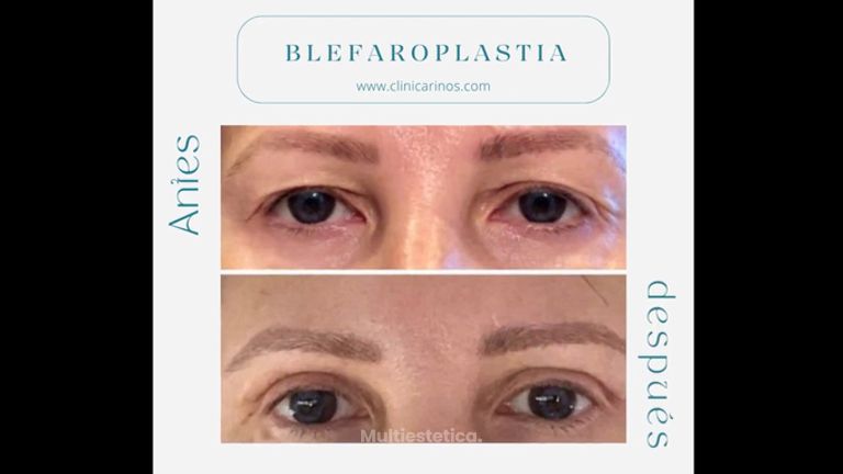 Blefaroplastia - Clínica Rinos