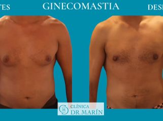 Ginecomastia - Clínica Dr. Pascual Marín