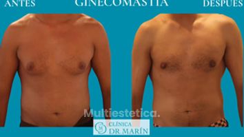 Ginecomastia - Clínica Dr. Pascual Marín
