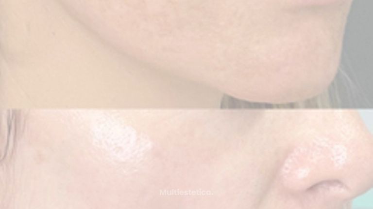 Historia antes y después láser manchas cara