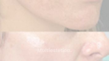 Historia antes y después láser manchas cara