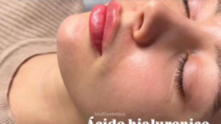 Labios - Medicina Estética Coimbra