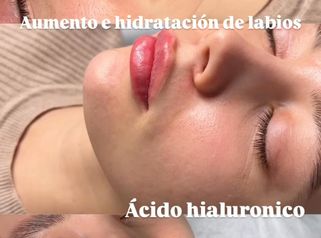 Labios - Medicina Estética Coimbra