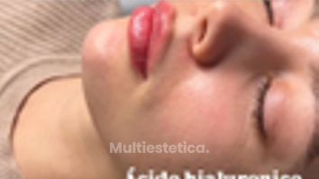 Labios - Medicina Estética Coimbra