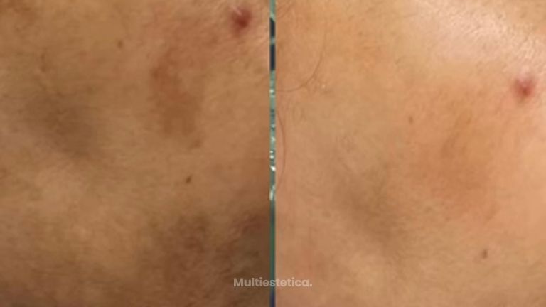 MELASMA - ✨Tratamiento✨