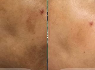 MELASMA - ✨Tratamiento✨