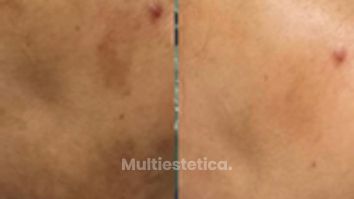 MELASMA - ✨Tratamiento✨