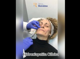 Rejuvenecimiento facial - Dr. Juan Sergio Fernandes Andrade