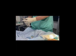 Labioplastia - Dr. José Luis Díaz Infante