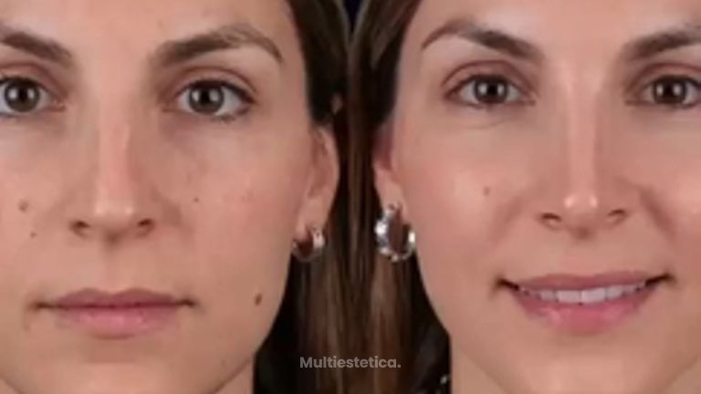 ✨ Un cambio sutil puede marcar una gran diferencia.Hoy compartimos el resultado de rinoplastia