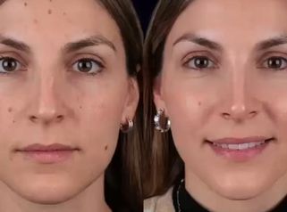 ✨ Un cambio sutil puede marcar una gran diferencia.Hoy compartimos el resultado de rinoplastia