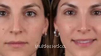 ✨ Un cambio sutil puede marcar una gran diferencia.Hoy compartimos el resultado de rinoplastia