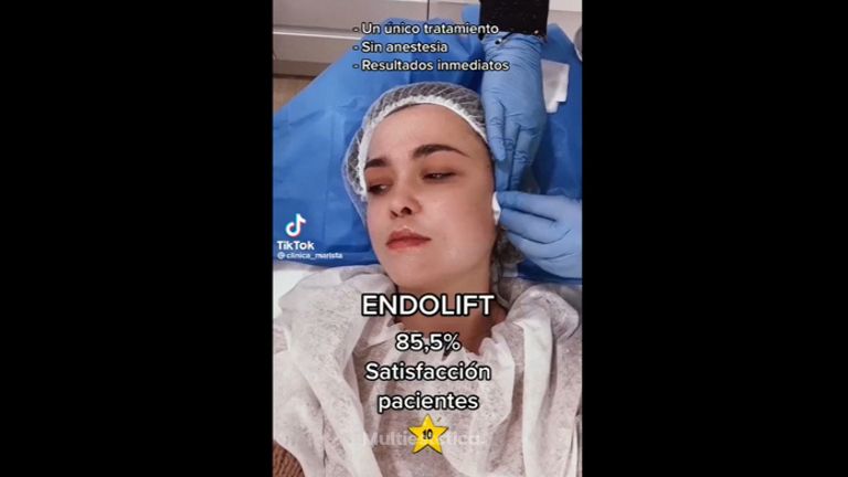 Endolift - Marista Clínica