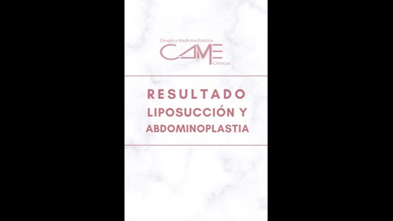 Liposucción + Abdominoplastia - Clínicas CAME