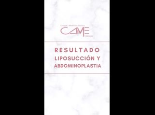 Liposucción + Abdominoplastia - Clínicas CAME