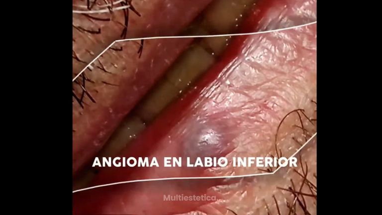 Eliminación angioma - Doctora Barba Martínez