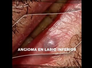 Eliminación angioma - Doctora Barba Martínez