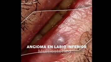 Eliminación angioma - Doctora Barba Martínez