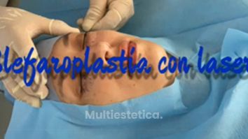 Her Láser - Blefaroplastia sin cirugía