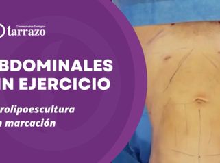 Marcación abdominal - Clínica Tarrazo