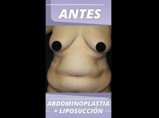 Abdominoplastia - Centro CEME