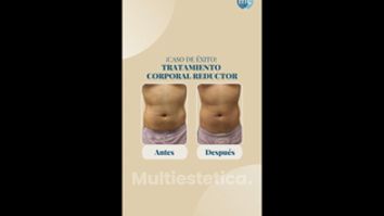 Mesoterapia - Medcare Health & Beauty