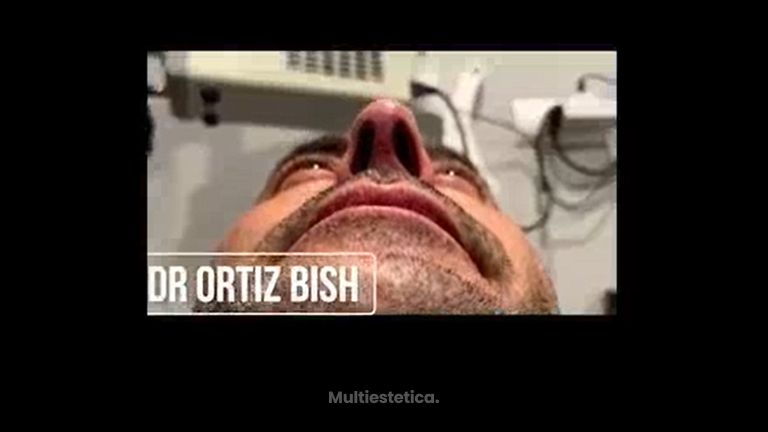 Dr Francisco Ortiz Bish Rinoplastia