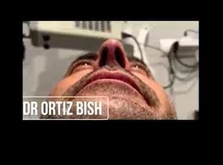 Dr Francisco Ortiz Bish Rinoplastia