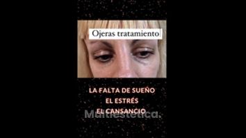 Eliminar ojeras - Clínica Lasernova