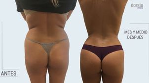 Dorsia Clinicas De Estética es especialista en Lipo Vaser Dorsia Clinicas De Estética es especialista en Lipo Vaser