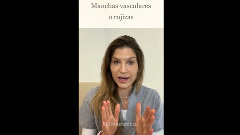 Manchas faciales parte I lesiones Vasculares - Clínica Graziella Moraes